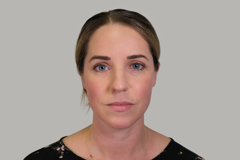 Rhinoplasty Before & After Gallery - Patient 139384 - Image 5
