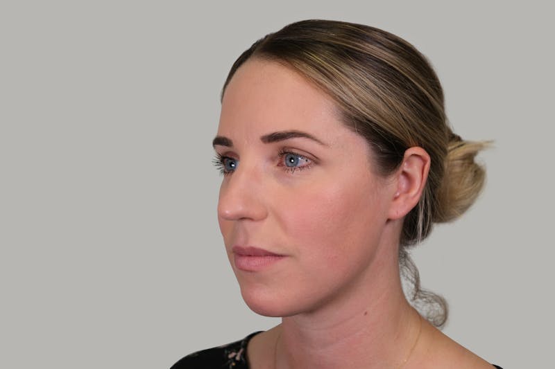 Rhinoplasty Before & After Gallery - Patient 139384 - Image 7