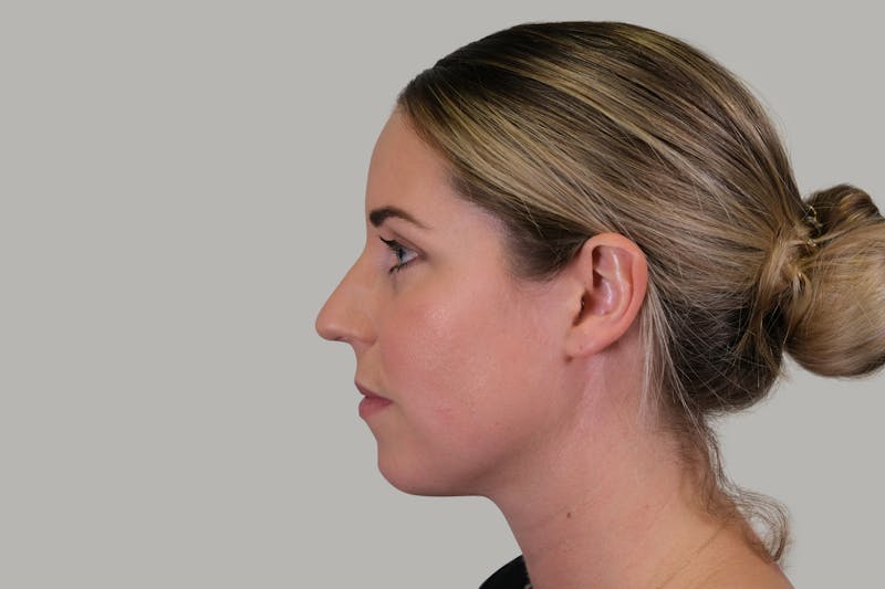 Rhinoplasty Before & After Gallery - Patient 139384 - Image 9