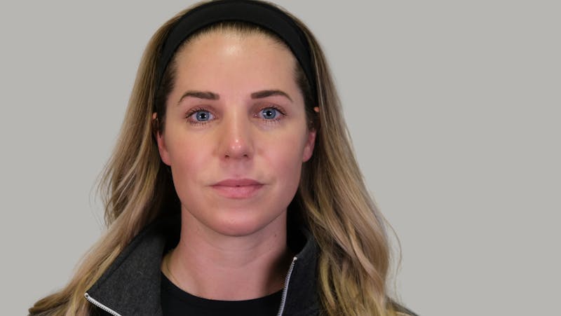Rhinoplasty Before & After Gallery - Patient 139384 - Image 6
