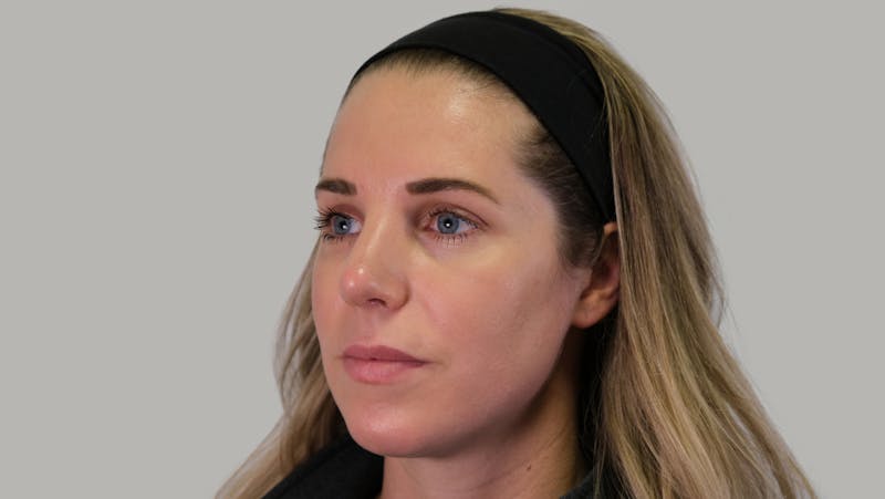 Rhinoplasty Before & After Gallery - Patient 139384 - Image 8