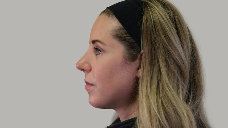 Rhinoplasty Before & After Gallery - Patient 139384 - Image 10
