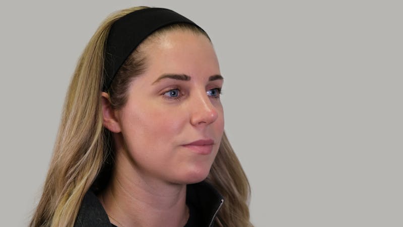 Rhinoplasty Before & After Gallery - Patient 139384 - Image 4