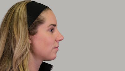 Rhinoplasty Before & After Gallery - Patient 139384 - Image 2
