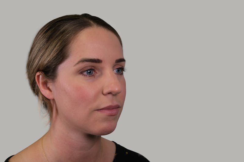 Rhinoplasty Before & After Gallery - Patient 139384 - Image 3