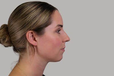 Rhinoplasty Before & After Gallery - Patient 139384 - Image 1
