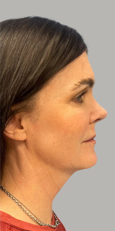 Revision Rhinoplasty Before & After Gallery - Patient 663713 - Image 2