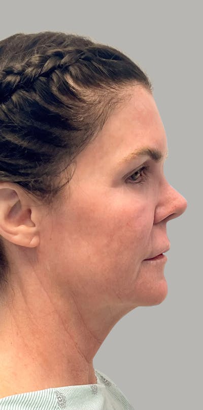 Revision Rhinoplasty Before & After Gallery - Patient 663713 - Image 1