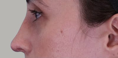 Revision Rhinoplasty Before & After Gallery - Patient 171395 - Image 2