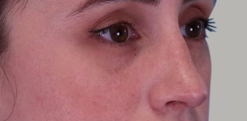 Revision Rhinoplasty Before & After Gallery - Patient 171395 - Image 4