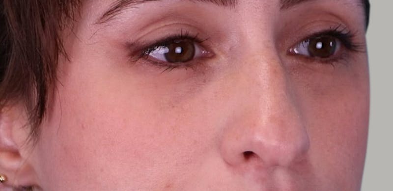 Revision Rhinoplasty Before & After Gallery - Patient 171395 - Image 3