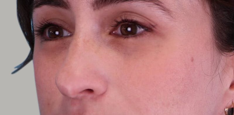 Revision Rhinoplasty Before & After Gallery - Patient 171395 - Image 5