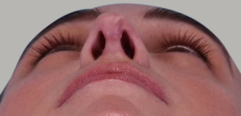 Revision Rhinoplasty Before & After Gallery - Patient 171395 - Image 8