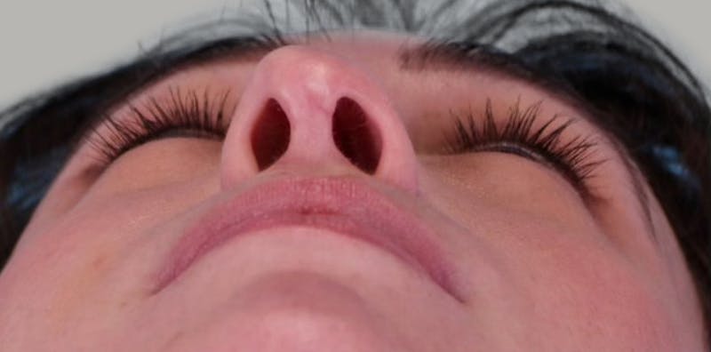 Revision Rhinoplasty Before & After Gallery - Patient 171395 - Image 7