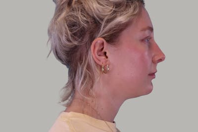 Neck Lift Before & After Gallery - Patient 407467 - Image 1