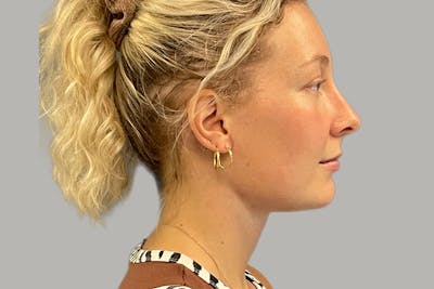 Neck Lift Before & After Gallery - Patient 407467 - Image 2
