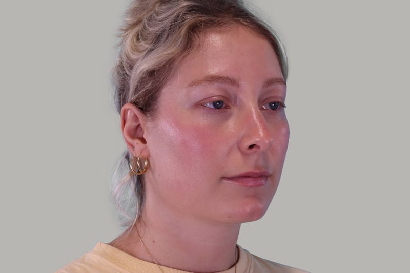 Neck Lift Before & After Gallery - Patient 407467 - Image 3