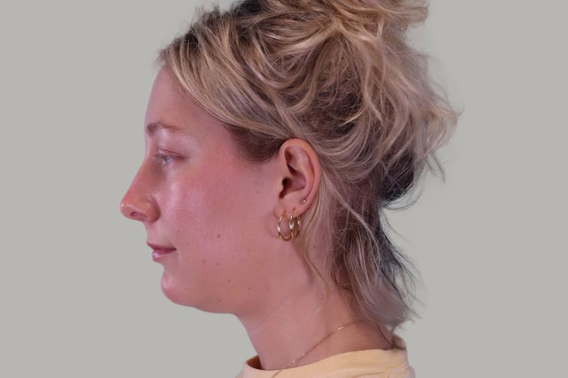 Neck Lift Before & After Gallery - Patient 407467 - Image 5