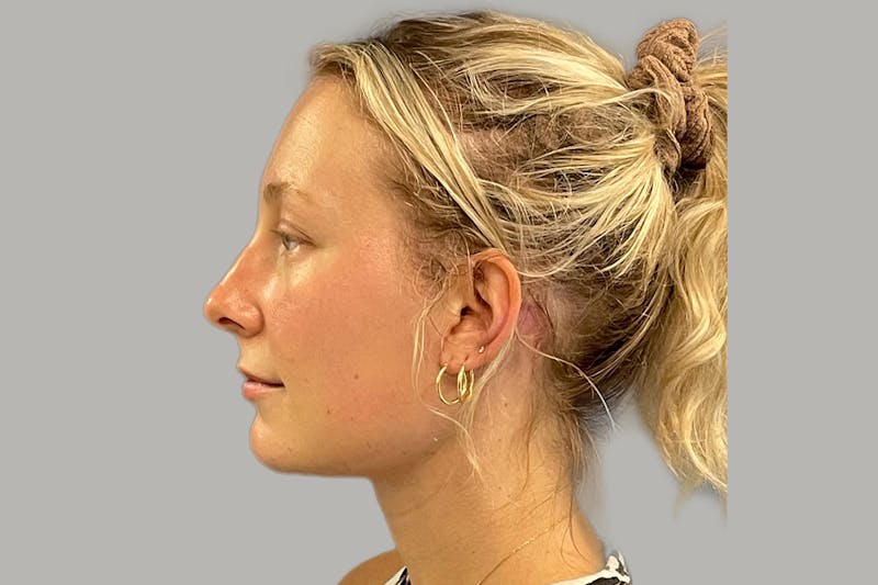 Neck Lift Before & After Gallery - Patient 407467 - Image 6