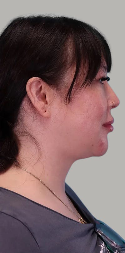 Chin Implant Before & After Gallery - Patient 401480 - Image 2