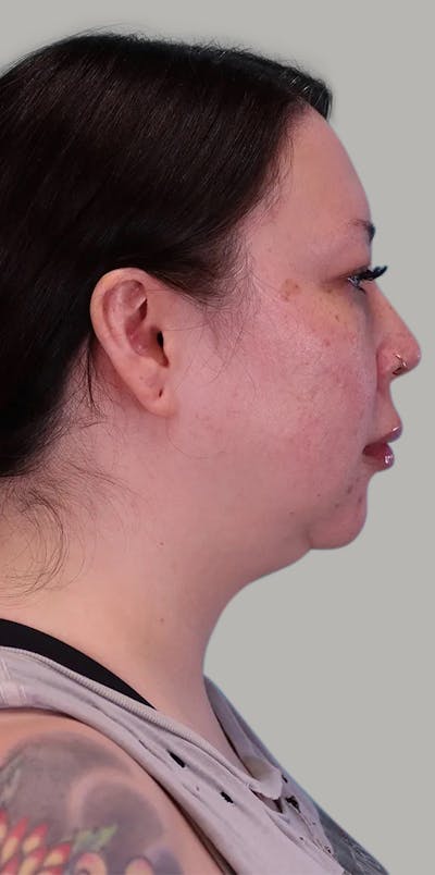 Chin Implant Before & After Gallery - Patient 401480 - Image 1