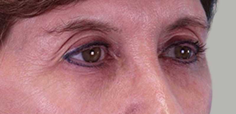 Upper Blepharoplasty Before & After Gallery - Patient 496761 - Image 3
