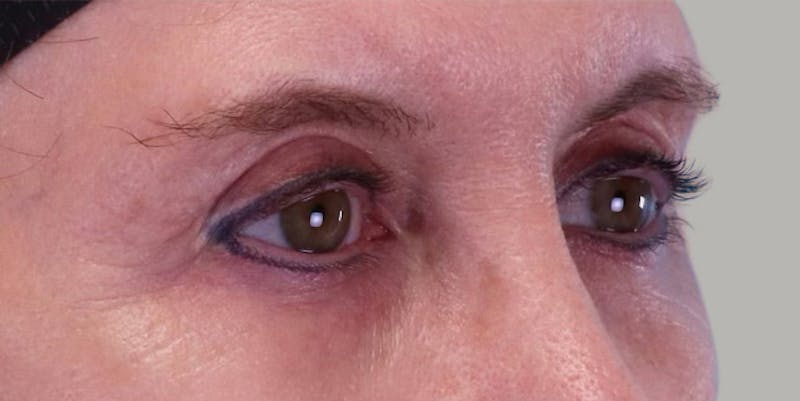Upper Blepharoplasty Before & After Gallery - Patient 496761 - Image 4