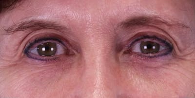 Upper Blepharoplasty Before & After Gallery - Patient 496761 - Image 1