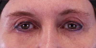 Upper Blepharoplasty Before & After Gallery - Patient 496761 - Image 2