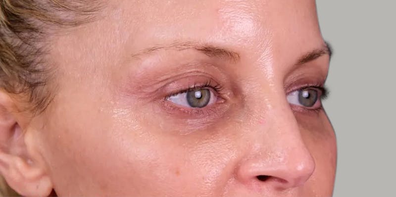 Upper Blepharoplasty Before & After Gallery - Patient 350868 - Image 5