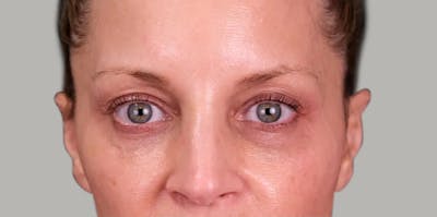Upper Blepharoplasty Before & After Gallery - Patient 350868 - Image 1