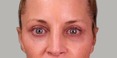 Upper Blepharoplasty Before & After Gallery - Patient 350868 - Image 2