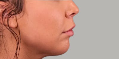 Lip Lift Before & After Gallery - Patient 389746 - Image 2