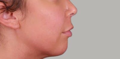Lip Lift Before & After Gallery - Patient 389746 - Image 1
