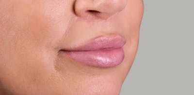 Lip Lift Before & After Gallery - Patient 136043 - Image 2