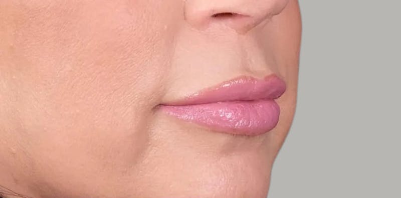 Lip Lift Before & After Gallery - Patient 136043 - Image 1
