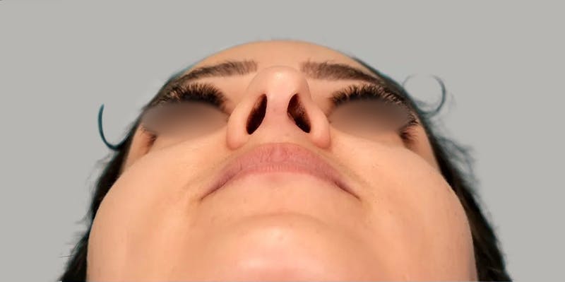 Revision Rhinoplasty Before & After Gallery - Patient 185114 - Image 5