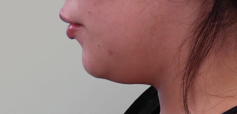 Neck Liposuction Before & After Gallery - Patient 268504 - Image 7