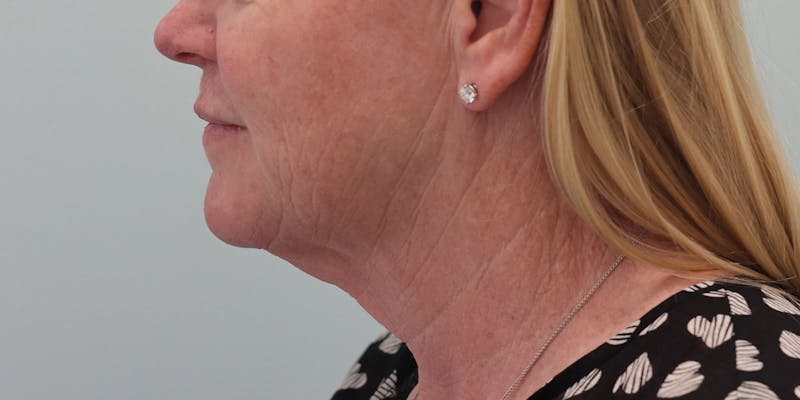 Facelift Before & After Gallery - Patient 194306 - Image 3