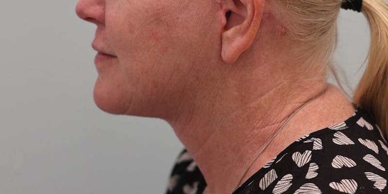 Facelift Before & After Gallery - Patient 194306 - Image 4