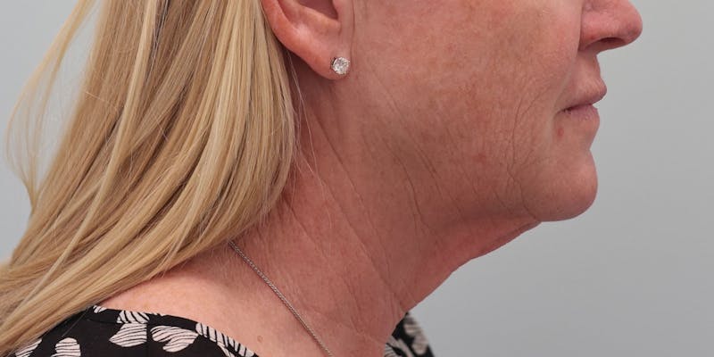 Facelift Before & After Gallery - Patient 194306 - Image 7
