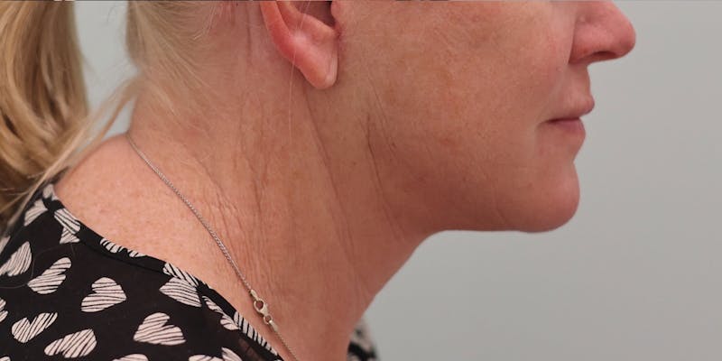 Facelift Before & After Gallery - Patient 194306 - Image 8