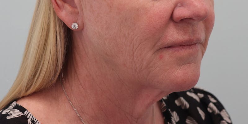 Facelift Before & After Gallery - Patient 194306 - Image 9