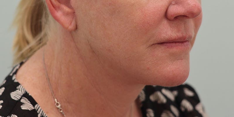 Facelift Before & After Gallery - Patient 194306 - Image 10