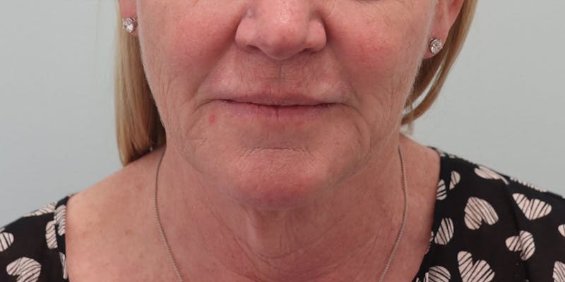 Facelift Before & After Gallery - Patient 194306 - Image 1