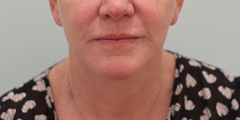 Facelift Before & After Gallery - Patient 194306 - Image 2