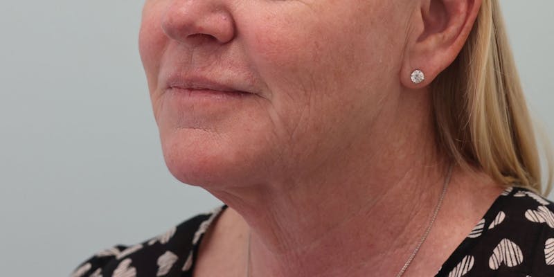 Facelift Before & After Gallery - Patient 194306 - Image 5