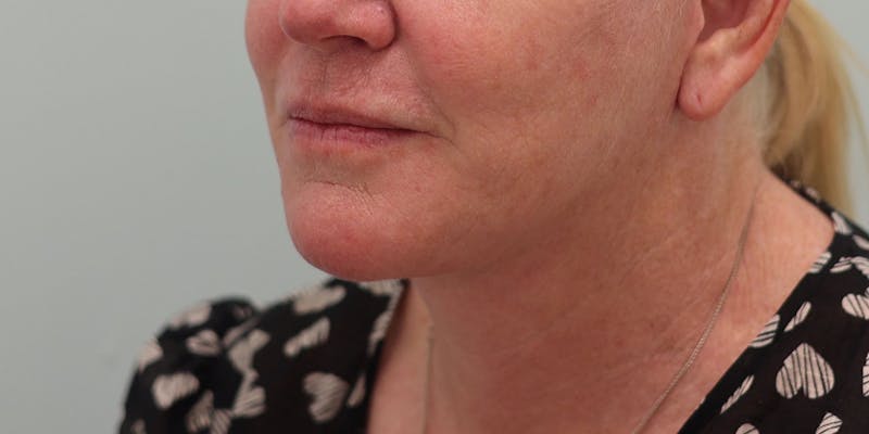 Facelift Before & After Gallery - Patient 194306 - Image 6