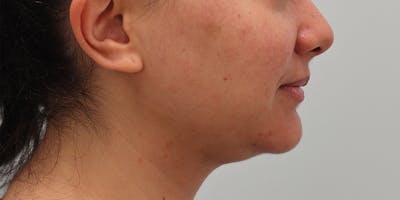 Neck Liposuction Before & After Gallery - Patient 820885 - Image 1