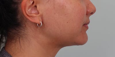 Neck Liposuction Before & After Gallery - Patient 820885 - Image 2